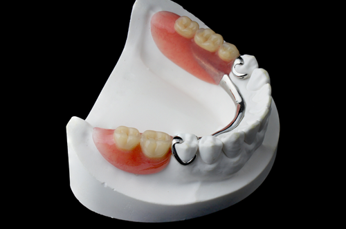 Tooth Replacement with a Partial Denture